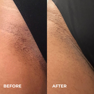 Mayuri Lab Ingrown Hair Smoothing Roller