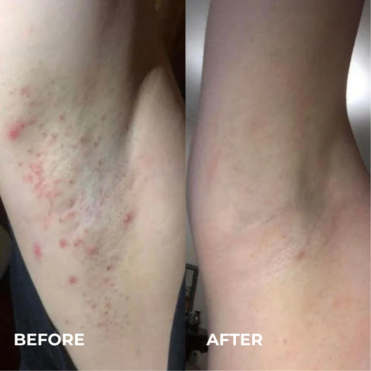 Mayuri Lab Ingrown Hair Smoothing Roller