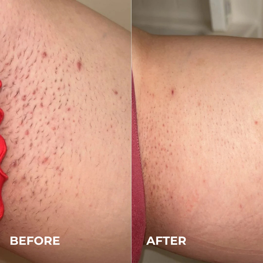 Mayuri Lab Ingrown Hair Smoothing Roller