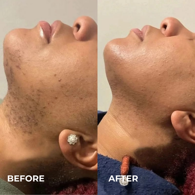 Mayuri Lab Ingrown Hair Smoothing Roller
