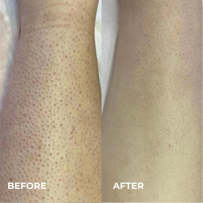 Mayuri Lab Ingrown Hair Smoothing Roller