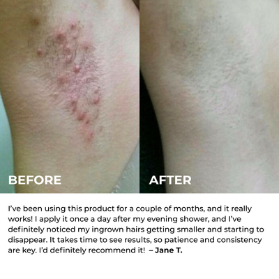 Mayuri Lab Ingrown Hair Smoothing Roller