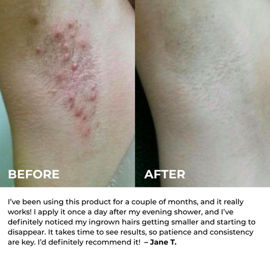 Mayuri Lab Ingrown Hair Smoothing Roller